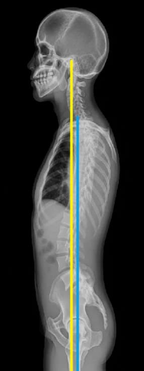 서서 찍은 측면 전신 X-ray — 경추 커브와 전신 정렬 기준선