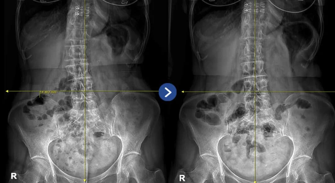 서서 찍은 전신 X-ray 비교 — 골반 높이 차이 측정선과 척추 정렬 기준선